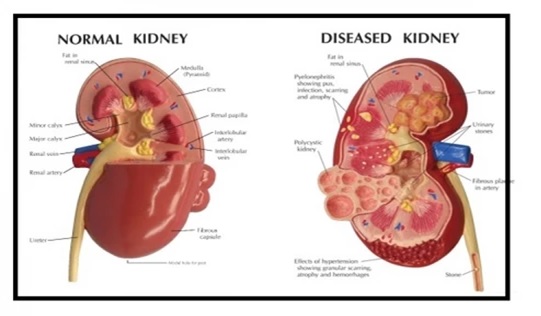 Infected Kidney